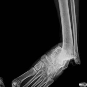 Album i broke my ankle on my birthday (Explicit) oleh DJ FENTANYL