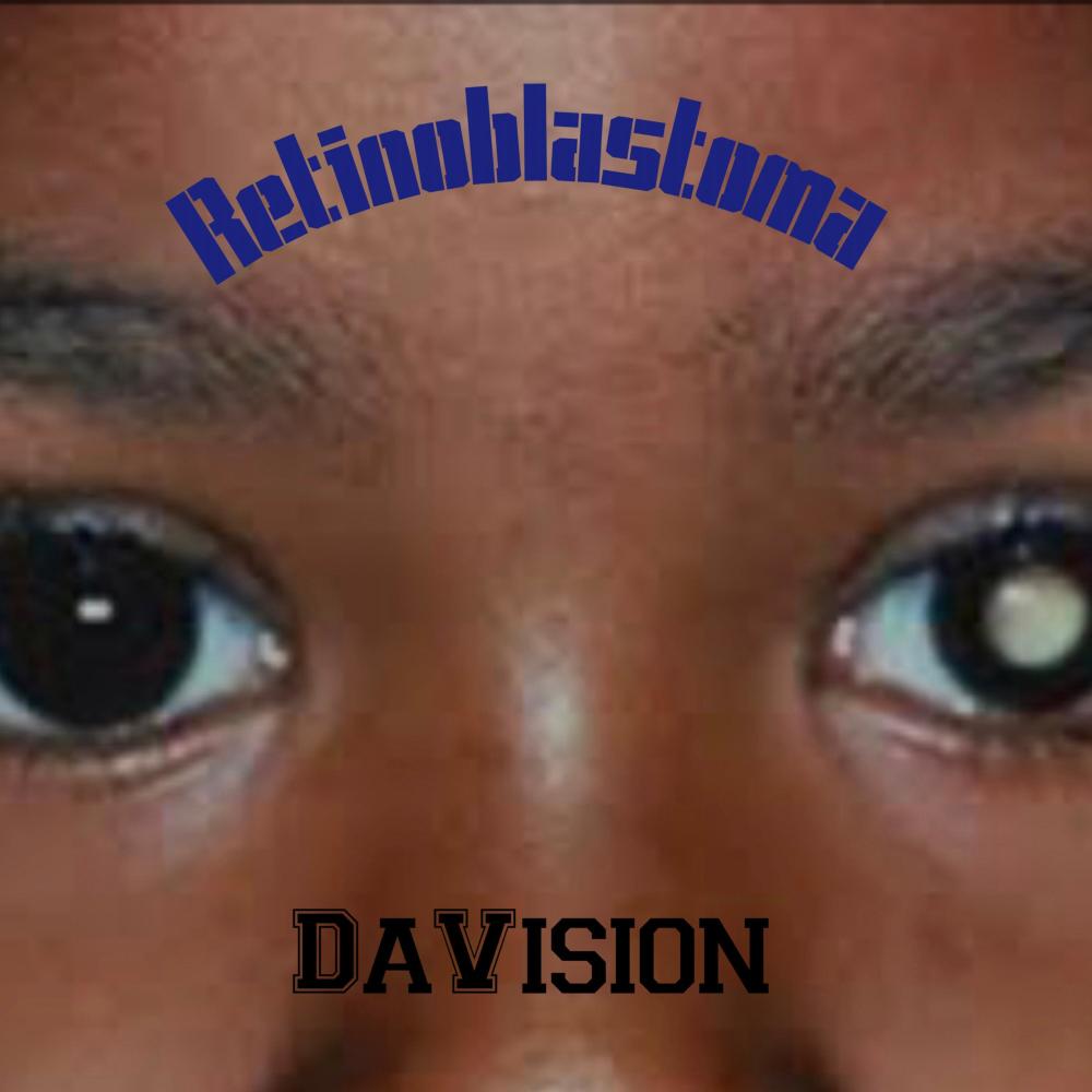 Retinoblastoma