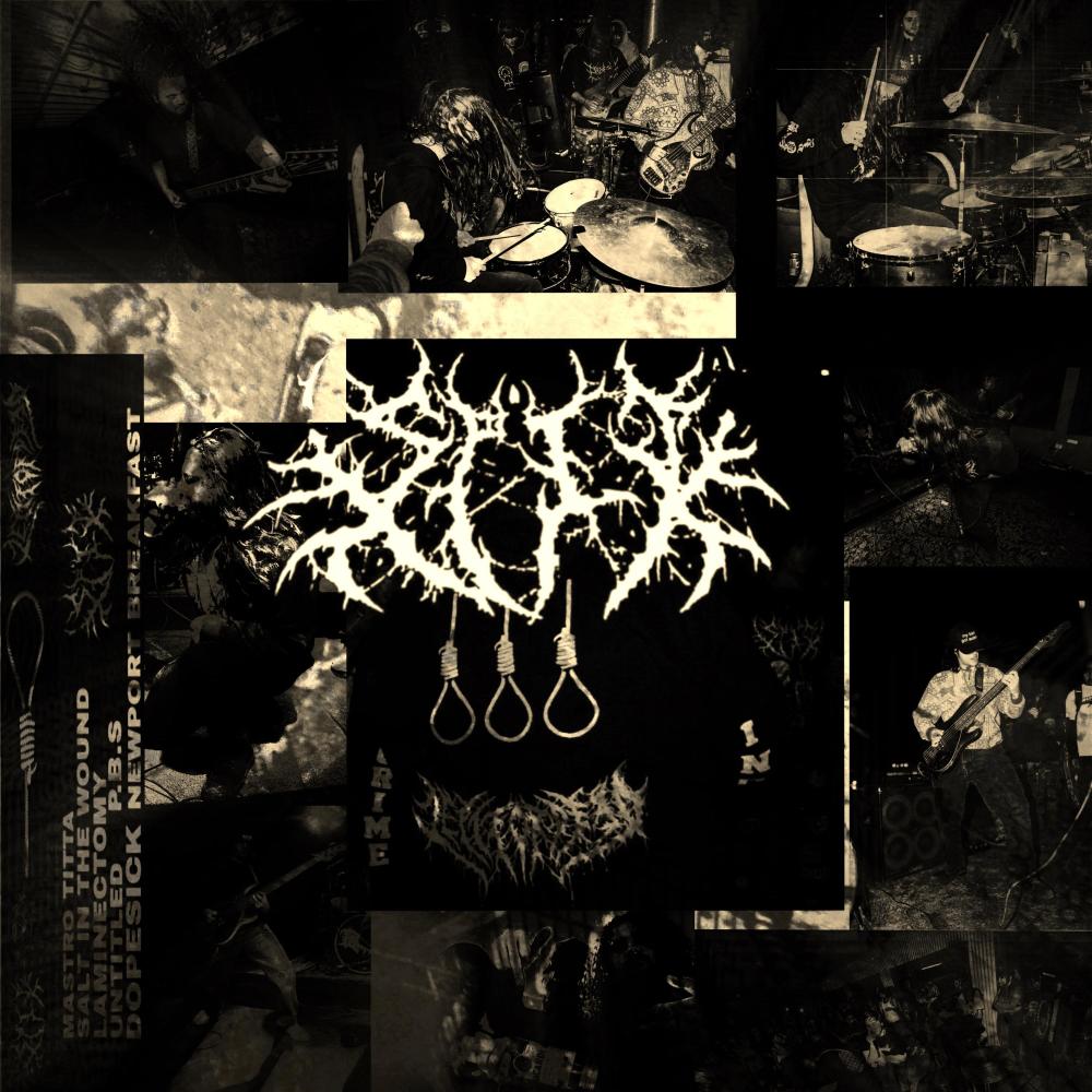 Laminectomy (Explicit)