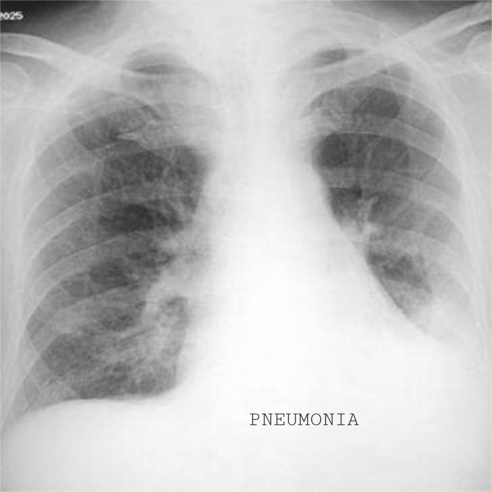 PNEUMONIA (Explicit)